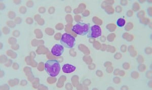 Un algoritmo logra organizar las mutaciones de la leucemia linfocítica