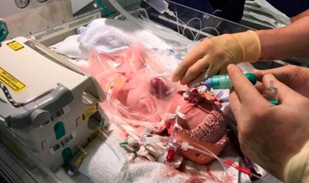 Un bebé sobrevive tras nacer con el corazón fuera del pecho