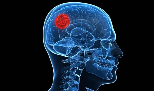 Investigadores españoles crean un "clasificador" para tratar de mejorar el diagnóstico del tumor cerebral intraaxial