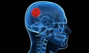 Un "clasificador" logra un 85% de eficacia diagnóstica en un tumor cerebral