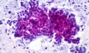 Un ensayo clínico revela nuevos subtipos de cáncer de páncreas avanzado