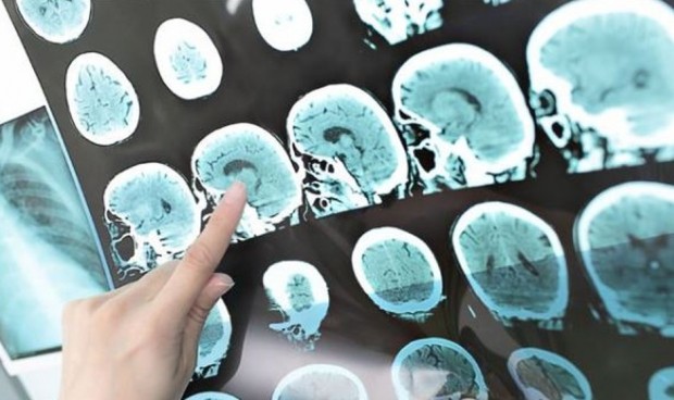 Un escáner cerebral por imágenes capaz de predecir el alzhéimer al 98%