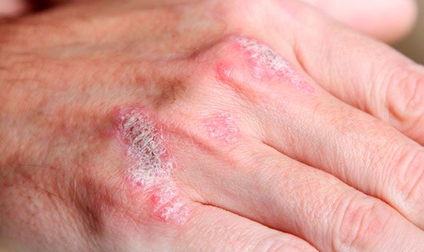 Un espacio virtual conciencia sobre la psoriasis en el Príncipe de Asturias