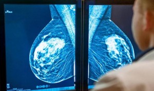 Un estudio analiza cómo evitar la quimioterapia en cáncer de mama HER-2+