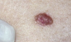 El melanoma, un tipo de cáncer de piel 