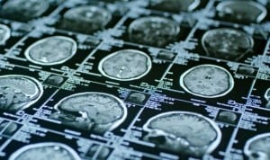 Un estudio muestra que la neuroimagen mejora la detección de esquizofrenia