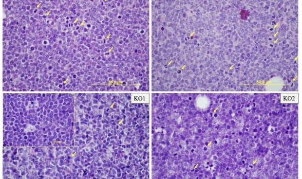 Un fármaco abre nuevas posibilidades para tratar la leucemia linfoblástica