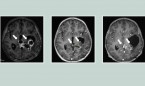 Un fármaco duplica la supervivencia de niños con tumores cerebrales