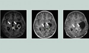  Una serie de escáneres cerebrales muestra un tumor que se reduce en respuesta al fármaco.