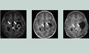 Un fármaco duplica la supervivencia de niños con tumores cerebrales