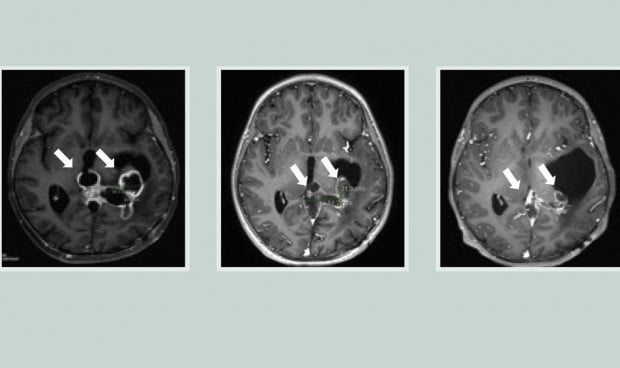  Una serie de escáneres cerebrales muestra un tumor que se reduce en respuesta al fármaco.