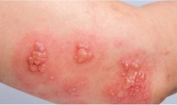 Un gel tópico logra reducir lesiones provocadas por el molusco contagioso