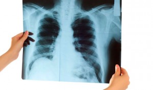 Un gen condiciona la respuesta a inmunoterapia en cáncer de pulmón