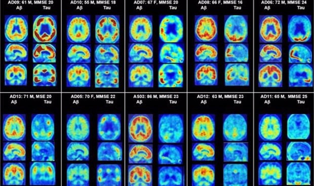 Un medicamento para el alzhéimer ayuda contra las resistencias antibióticas