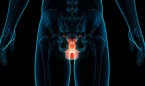Un nuevo análisis de sangre detecta un 94% de los cánceres de próstata