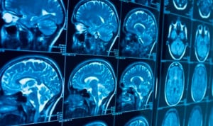 Un nuevo antipsicótico oral mejora síntomas y adherencia en esquizofrenia