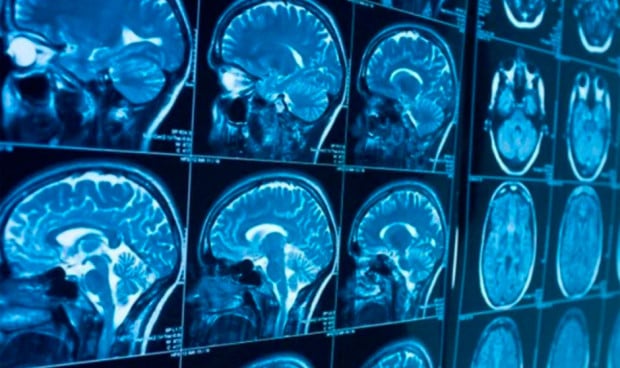 Un nuevo antipsicótico oral mejora síntomas y adherencia en esquizofrenia