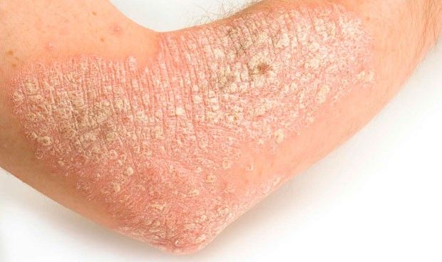 Un nuevo estudio revela la complejidad genética de la psoriasis