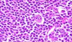 Un test de sangre 'predice' el éxito de la terapia de un tipo de linfoma