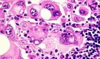Un test sanguneo detecta el melanoma en estadios tempranos	