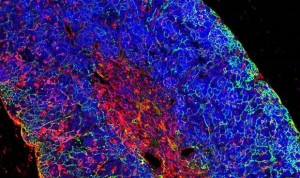 Un tratamiento contra leucemia en menores de 1 año duplica la supervivencia