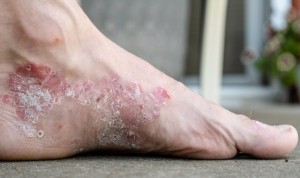 Una célula de la piel ayuda a tratar la dermatitis atópica y la psoriasis