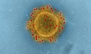 Una encefalitis delata al coronavirus como causa de patología nerviosa