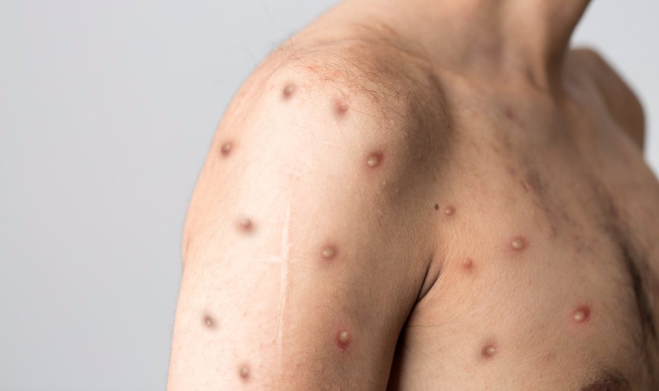 Una encefalitis, detrás de la primera muerte por viruela del mono en España