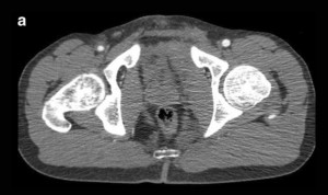 Una tomografía arterial extra no mejora la derivación para una angiografía