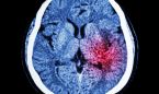 Una larga depresin se vincula con la inflamacin y modificacin cerebral