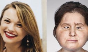 Una mujer de EEUU, la más joven del mundo en recibir un trasplante de cara