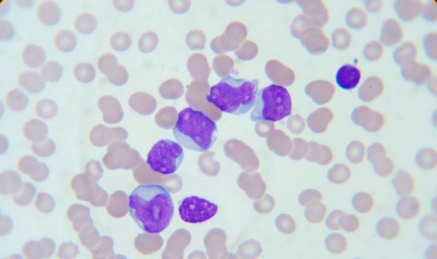 Una nueva técnica detecta en la sangre los cambios genéticos de la leucemia