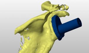 Una nueva técnica en 3D para prótesis mejora la supervivencia del implante