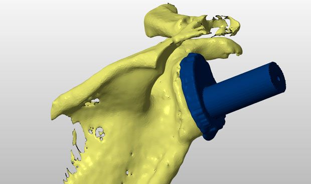 Una nueva técnica en 3D para prótesis mejora la supervivencia del implante