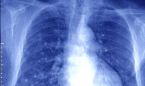 Una nueva técnica permite el diagnóstico precoz del cáncer de pulmón