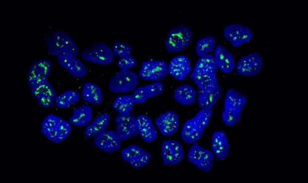 Una protena mantiene dormidas las clulas en la metstasis de mama