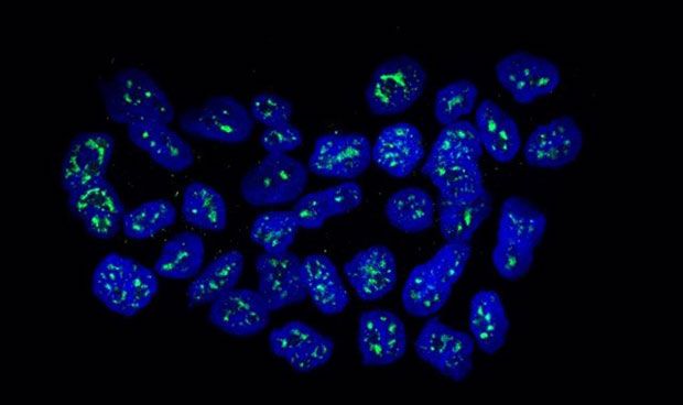 Una proteína mantiene dormidas las células en la metástasis de mama