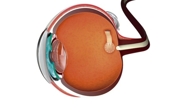 Una prótesis electrónica es capaz de devolver la visión parcial a ciegos