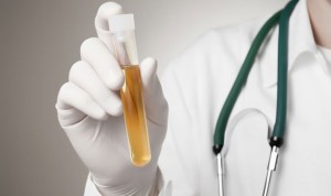 Una prueba detecta el cáncer de colon en la orina