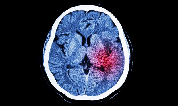Una técnica permite ampliar el margen frente al ictus hasta las 24 horas