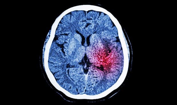 Una técnica permite ampliar el margen frente al ictus hasta las 24 horas