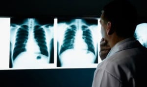 Una tecnología que predice cambios genéticos tratará el cáncer de pulmón