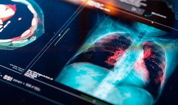 Una terapia combinada eleva un 20% la supervivencia en cáncer de pulmón