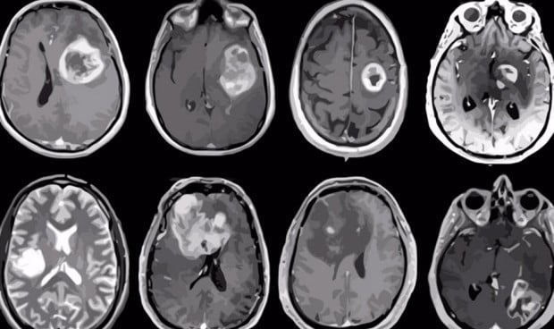 Una vacuna consigue potenciar la terapia CAR-T frente a tumores sólidos