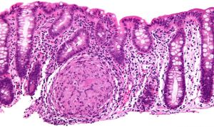 Unos nuevos reguladores controlan la inflamación de la enfermedad de Crohn