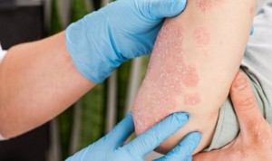 Covid | Dermatología recomienda usar vacunas ARNm en personas con psoriasis