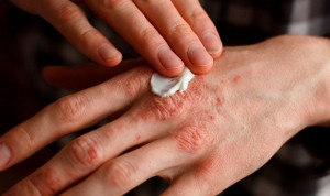 Vinculan el tratamiento de psoriasis con mejoras en una enfermedad cardiaca