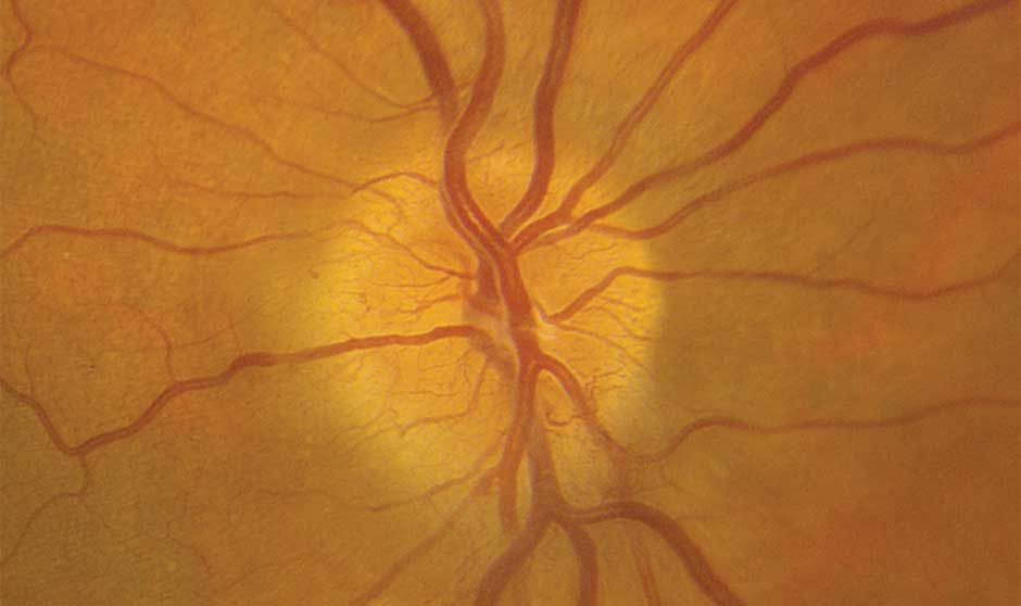 La semaglutida, relacionada con un tipo de ceguera poco frecuente