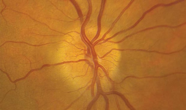 La semaglutida, relacionada con un tipo de ceguera poco frecuente