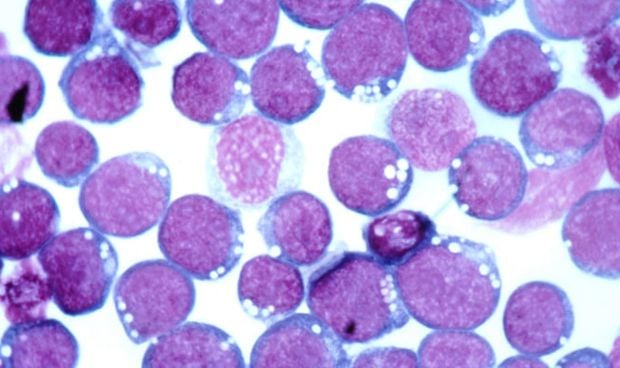 Vinculan el virus que provoca mononucleosis con 7 enfermedades graves más